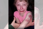 girl, school bus, 10 year old special needs child brutally bitten on arm while returning home in school bus, Special needs
