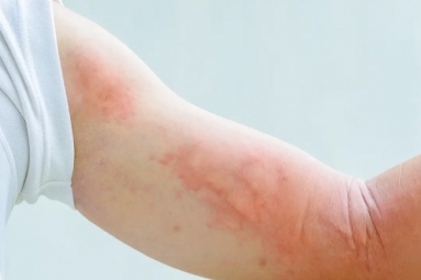 Dermatological symptoms could be a sign for Covid-19 infection