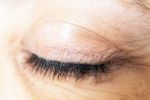 Eyelash Dandruff updates, Eyelash Dandruff updates, all about eyelash dandruff, Eye infections