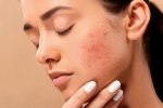 skin, acne, 10 ways to get rid of pimples at home, Acne