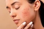 acne, acne, 10 ways to get rid of pimples at home, Skin care products