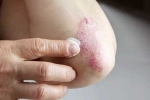 Skin disorders related, Skin disorders health issues, five common skin disorders and their symptoms, Skin disorders