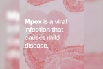 health emergency, mpox in Africa, mpox emergency again, Back pain