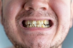 Nicotine stains irreversible, Nicotine stains latest breaking, are nicotine stains on your teeth irreversible, Recession