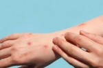 Monkeypox study, Monkeypox breaking news, study says that the symptoms of monkeypox are different from earlier, Tedros adhanom ghebreyesus